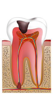 重度の虫歯