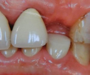 前歯の被せ物治療例