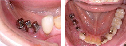 右下5・6・7番目の奥歯インプラント(68才女性)
