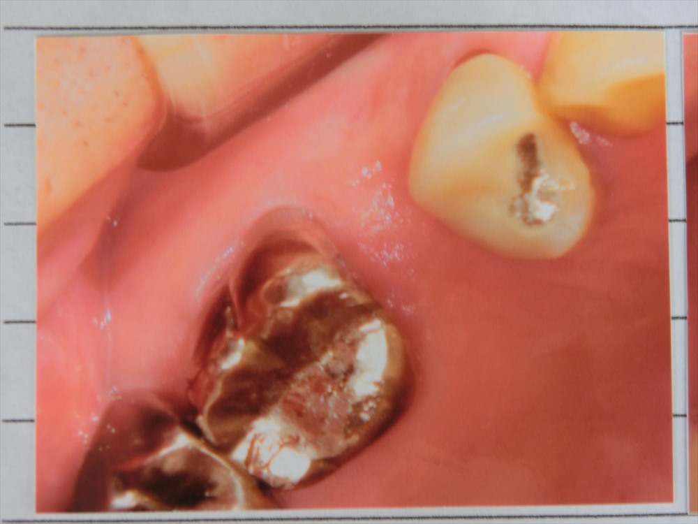 奥歯のインプラント治療例1